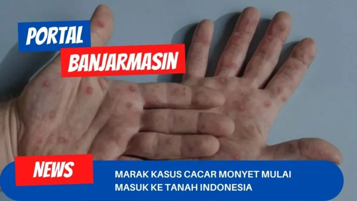 Marak Kasus Cacar Monyet Mulai Masuk Ke Tanah Indonesia Marak Kasus Cacar Monyet Mulai Masuk Ke Tanah Indonesia
